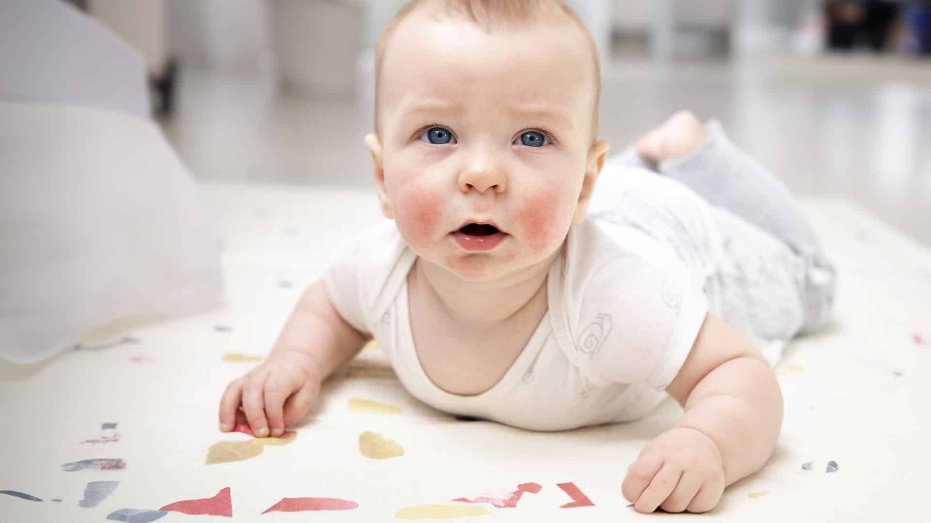 Bolinhas no rosto do bebê semelhantes a eczema