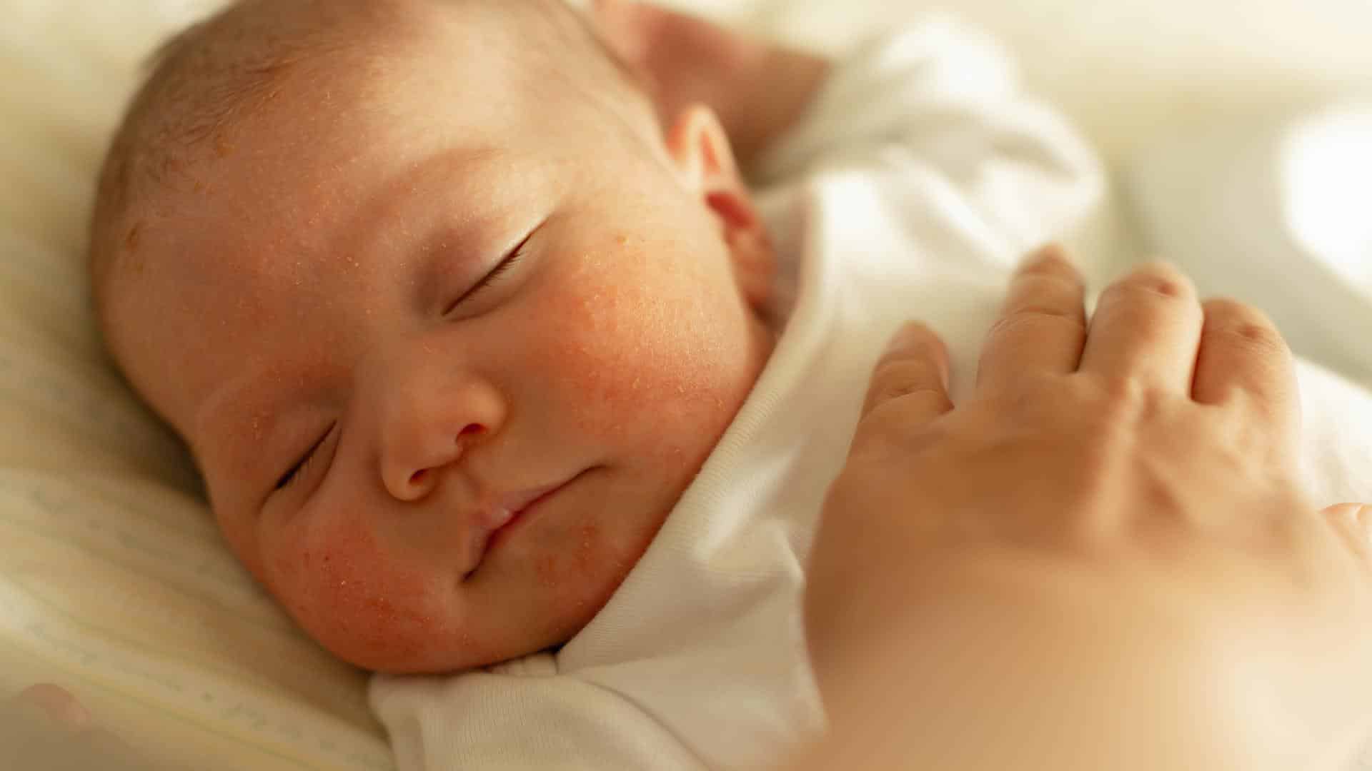 Bebê com alergia na pele