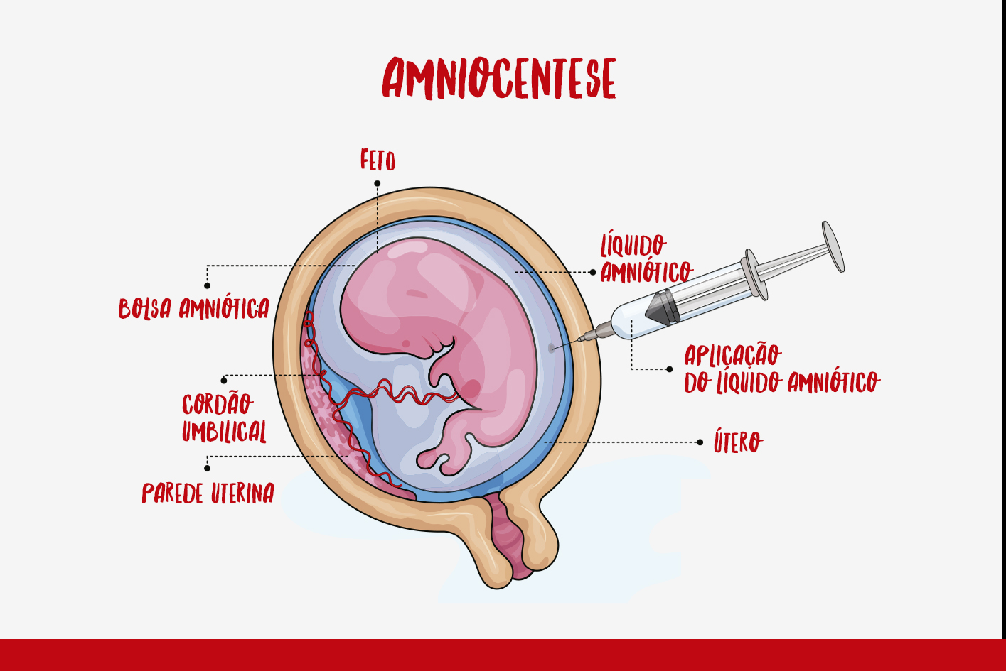 Amniocentese