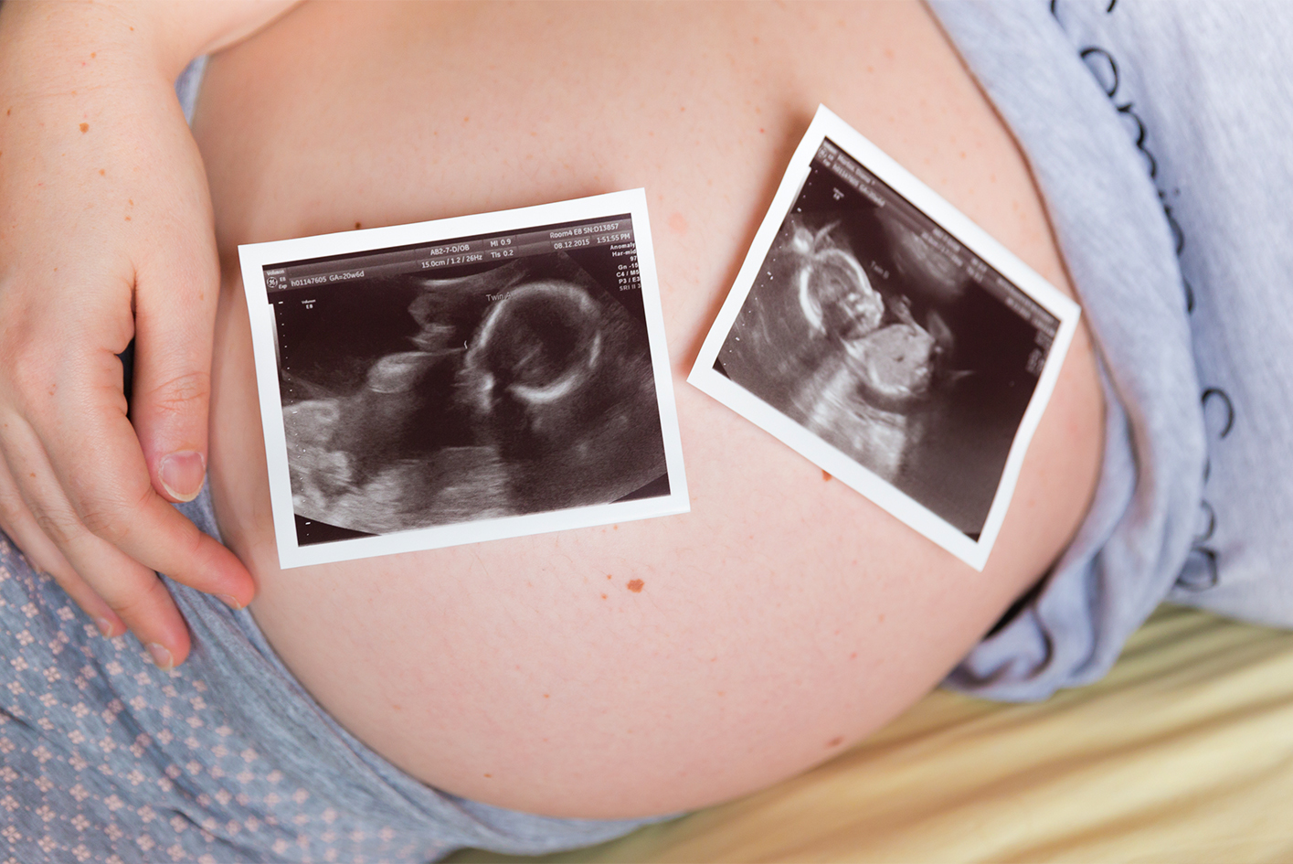 Imagens de ultrassom de uma gestação gemelar