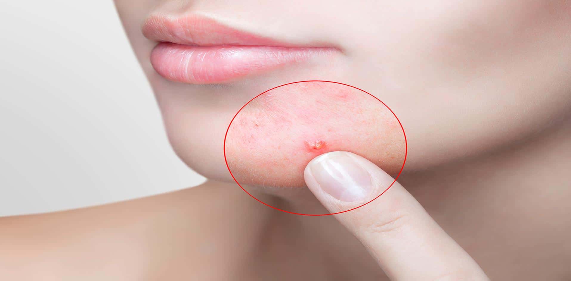 Acne em pele de mulher